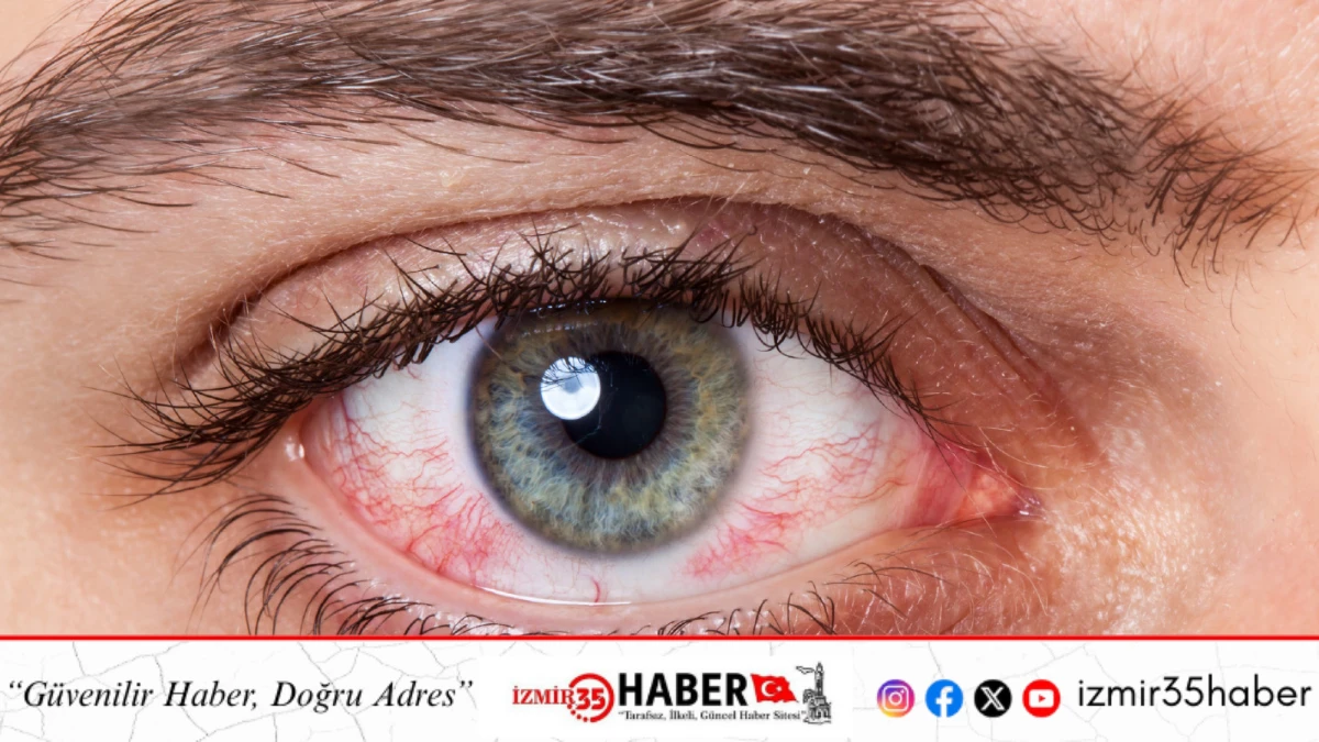 G&ouml;rme Sağlığını Tehdit Eden Fotokeratite Dikkat: